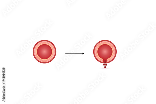 Hemophilia, a bleeding disorder that slows the blood clotting. Haemophilia (Coagulation disorder). Damaged blood vessel, hemorrhage. Healthy blood vessel after bleeding. Vector illustration..