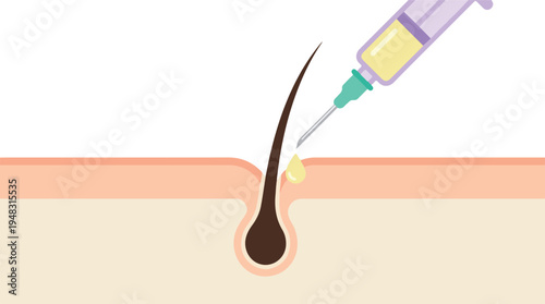 Hair growth treatment: Syringe injecting serum into hair follicle and scalp