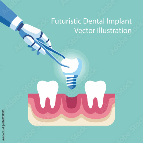 This vector graphic depicts a robotic hand holding a dental implant while approaching gum tissue, portraying cutting-edge technology in dental care advancements.