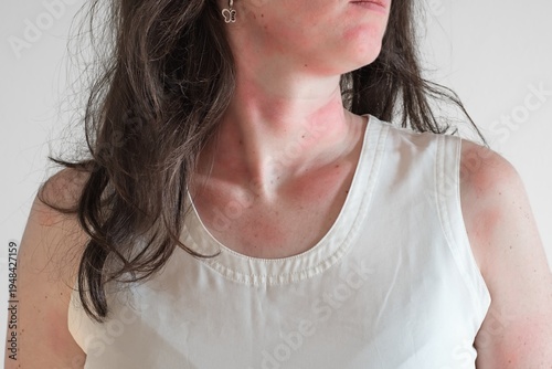 Allergic skin reaction on the female neck and face