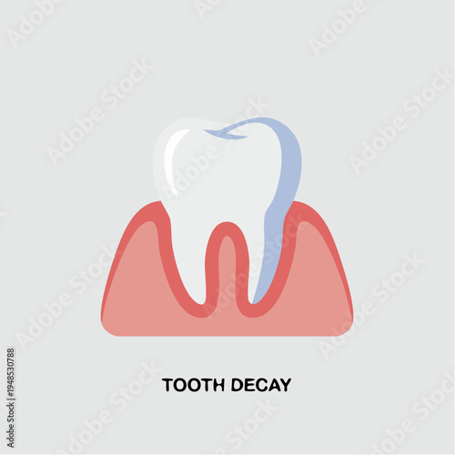 Tooth decay illustration with gum and root.