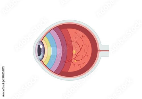 Crosssection diagram of a human eye showing internal layers and retinal anomalies