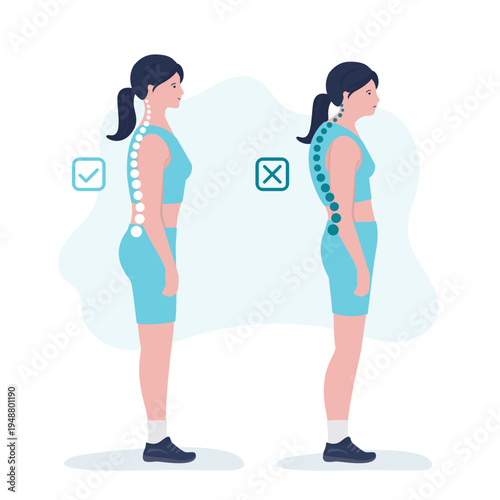 Educational poster, disorders infographic. Kyphotic posture. Sick woman full-length, side view shows deformation of rounded shoulders, spine curvature, shortened and tens muscles.