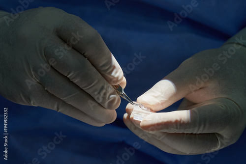 Foto Ophthalmic surgeon holding intraocular lens with tweezers during eye surgery preparation, close-up of sterile medical procedure