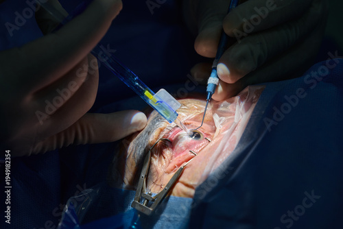 Foto Ophthalmic surgeon performing cataract surgery with intraocular lens implantation, close-up of eye microsurgery in operating room