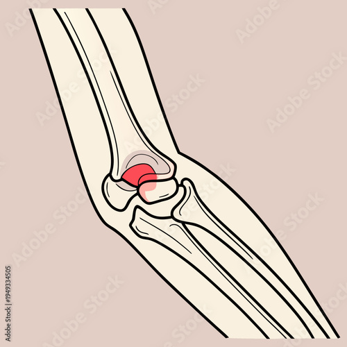 A medical illustration of a human elbow joint with highlighted inflammation