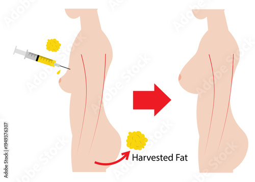  breast fat transfer, fat grafting,  cosmetic procedure ,  liposuction, medical procedure, Fat Transfer Breast Augmentation, Affordable Breast Fat Grafting , Lipofilling