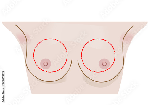  breast reduction surgery, breast lift , mastopexy, breast self-awareness techniques, 