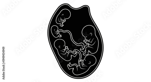Black silhouette illustration of a human womb containing five fetuses, representing a multiple pregnancy of quintuplets.