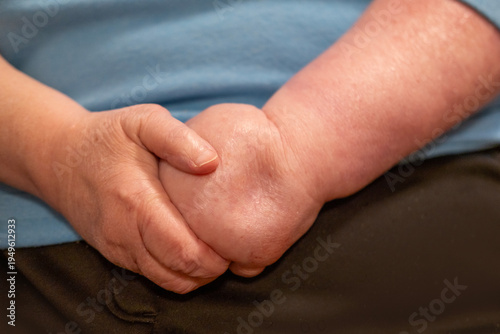 severely swollen paralyzed hand, edema and inflammation, clinical observation lymphatic, vascular disorder, healthcare, palliative settings disabled individuals managing long-term physical impairment