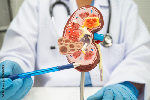 Quadro su tela Kidney disease, Chronic kidney disease ckd, Doctor hold human model