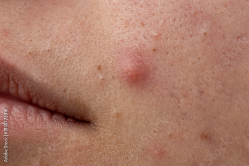 Fotografija Pimple on epidermis with bumps and sebum