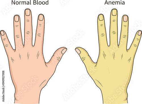 Anemia symptom comparison illustration showing normal hand and pale hand skin color medical diagnostic concept healthcare vector isolated background
