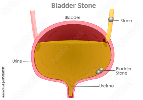 Urinary bladder stones are crystallized minerals that form in the bladder. anatomical view of the disease, cross section. Illustration vector