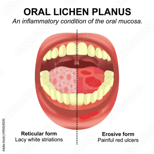 Oral Lichen Planus Medical Infographic Flashcard