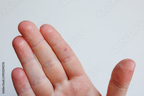 Fotografía Close up of splinter in child finger with dry irritated skin dermatology concept