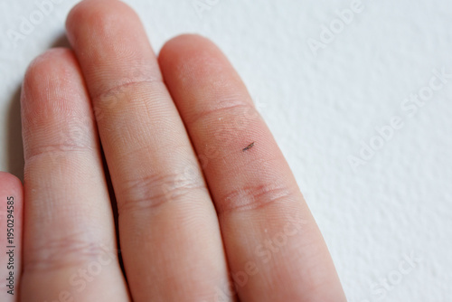 Foto Macro view of small splinter in child finger skin medical dermatology problem