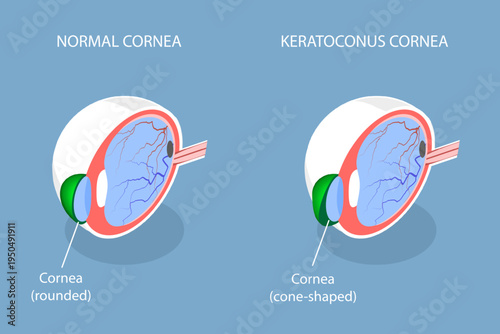 3D Isometric Flat Vector Illustration of Keratoconus Cornea, Eye Disorder