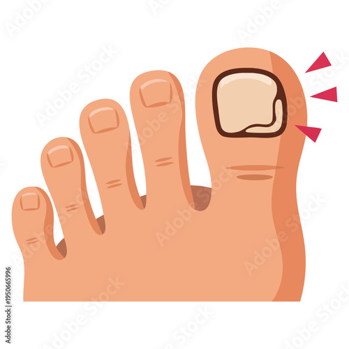 Swollen toe cartoon vector showing person feet with nail disease or infection foot with onychomycosis or fungus on fingers medical health awareness illustration
