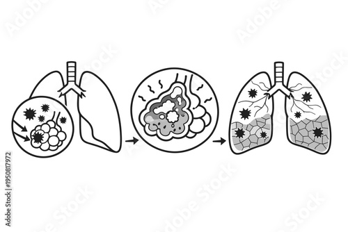 Silicosis progression vector illustration showing inhaled silica dust injuring alveoli, triggering inflammation, and leading to permanent lung scarring, fibrosis, and respiratory disease stages.
