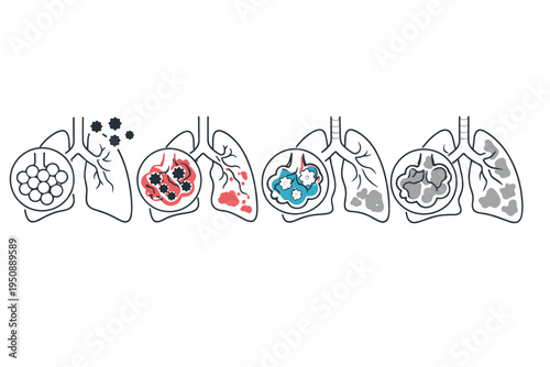 Vector Illustration of Silicosis Progression Showing How Inhaled Silica Dust Injures Alveoli, Triggering Inflammation, Fibrosis, and Permanent Lung Scarring in Occupational Respiratory Diseases.