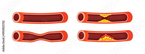 Illustration types of angina isolated on white background.