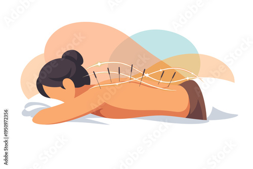 Acupuncture treatment on a persons back with needles.