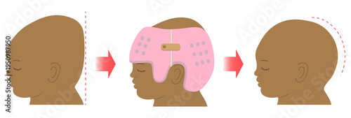 Before and after comparison diagram showing infant cranial correction with helmet therapy