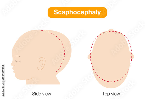 babies with plagiocephaly, brachycephaly, and dolichocephaly showing head shape deformities, top and side view