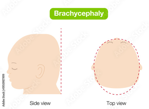 babies with plagiocephaly, brachycephaly, and dolichocephaly showing head shape deformities, top and side view