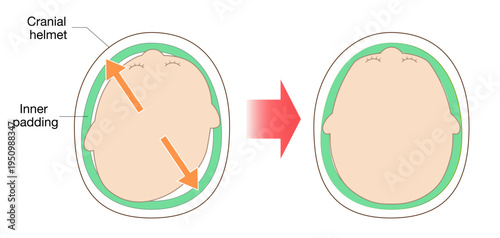Diagram explaining helmet therapy for plagiocephaly with cranial correction through guided growth