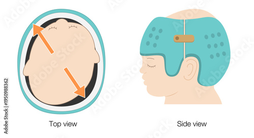 Diagram explaining helmet therapy for plagiocephaly with cranial correction through guided growth