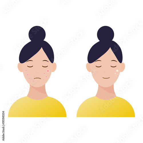 Acne treatment concept showing before and after clear skin on female face. vector illustration