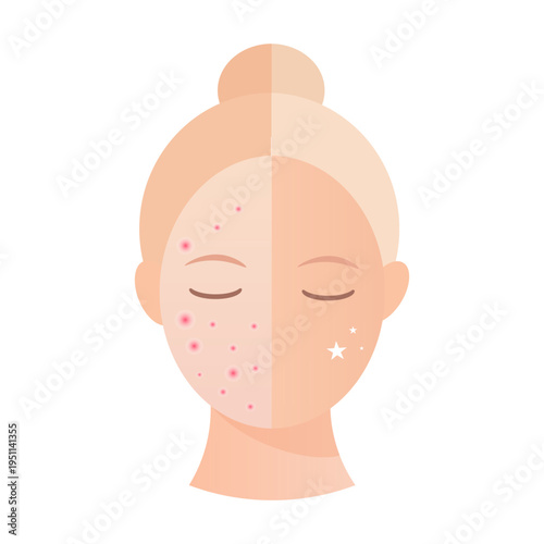 Acne and clear skin comparison face. vector illustration