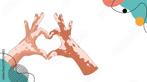Two human hands with vitiligo skin condition coming together to form a heart shape against an abstract background.