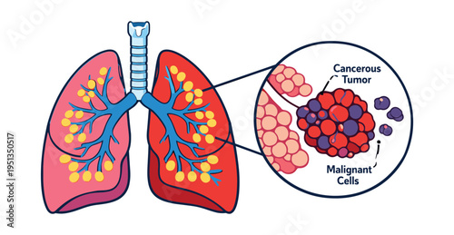 Lungs with a magnified view of a cancerous tumor and malignant cells, representing oncology, pathology, and medical research