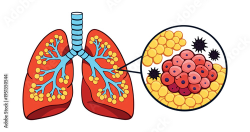 Human lungs with a magnified view of alveoli displaying a cancerous tumor, malignant cells, and viral particles