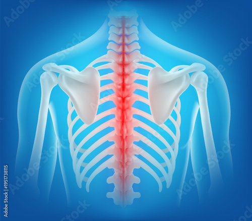 3D vector illustration showing  posterior view of the human upper torso skeletal structure rib cage scapulae localized inflammation chronic back pain or spinal injury