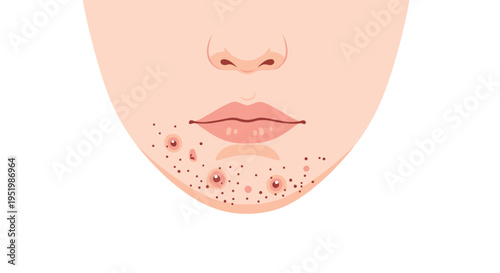 The front view of a human chin and mouth area shows multiple ingrown hairs and inflamed pustules.