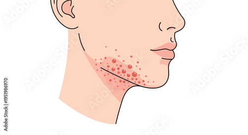 A side profile of a human face exhibits red, irritated skin with bumps along the jawline, indicating razor burn.