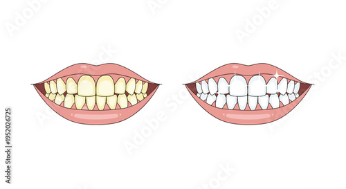 Two open mouths display a comparison between yellowed teeth and brilliantly white, sparkling teeth.