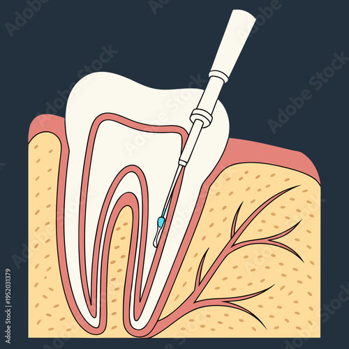 Cross section of human molar receiving endodontic root canal treatment with instrumentation