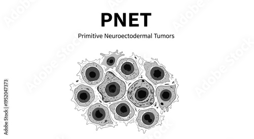 "PNET - Primitive Neuroectodermal Tumors medical illustration showing small round blue cell tumor cluster."