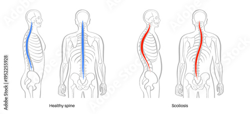 Scoliosis spine deformity