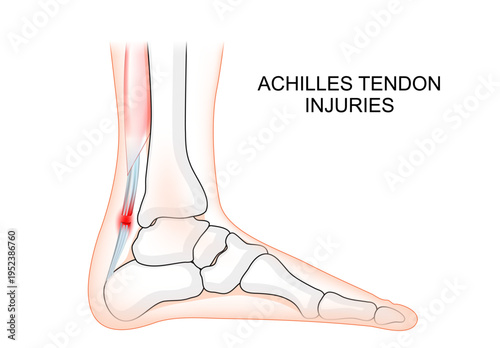 Achilles tendon Injuries. Human foot with bones and Achilles tendon.