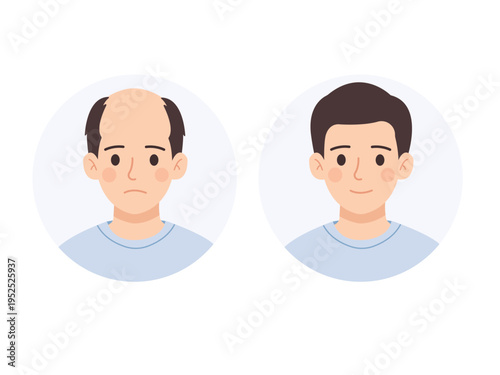 Hair restoration before and after flat vector illustration of hair regrowth and thinning hair concept