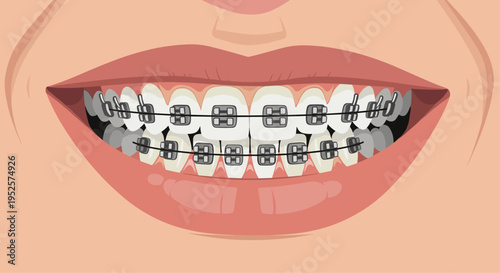 Close-up of a human smile with metallic dental braces on teeth for orthodontic treatment and straight smile alignment.