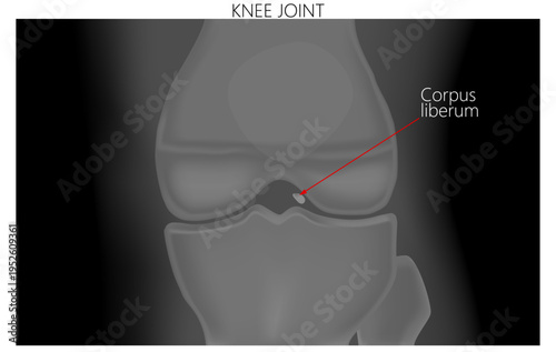 Corpus liberum. Knee joint mouse. X ray of the human knee joint