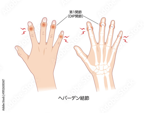 へバーデン結節の症状、右手とその骨