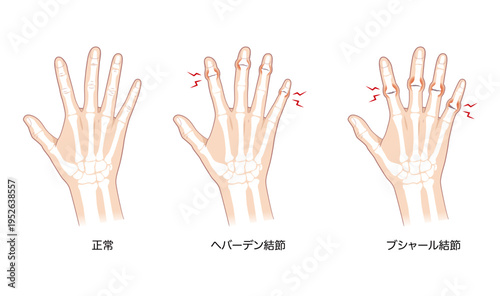 正常な手指とへバーデン結節、ブシャール結節の骨